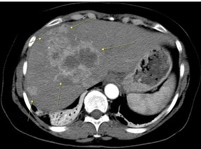 CT Scan - Hepatocellular Carcinoma