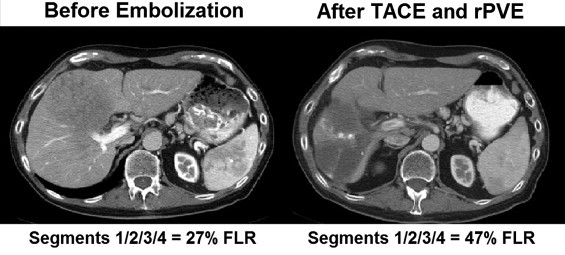 Portovenous Embolization