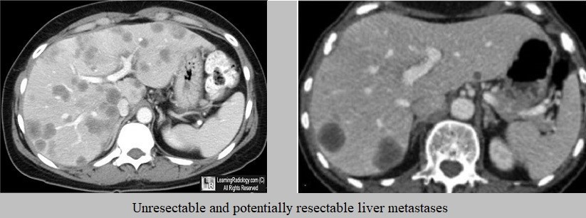 Unresectable and Resectable Liver Metastases