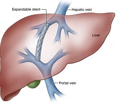 TIPS Procedure