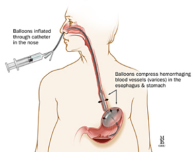 Balloon Tamponade