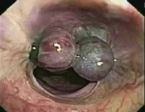 Endoscopic Banding of Bleeding Gastroesophageal Varices