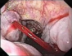 Bleeding Gastroesophageal Varices