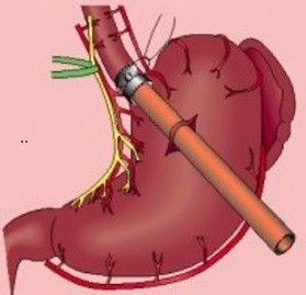 Esophageal Transection