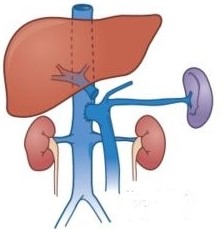 End-to-Side Portacaval Shunt
