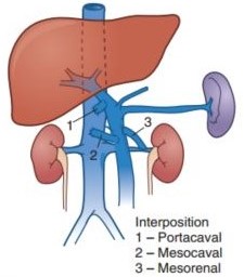 Interposition Portacaval Shunt