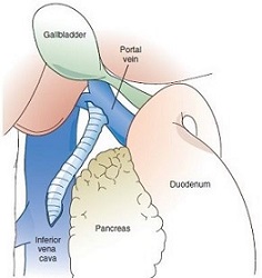 Partial Portacaval Shunt