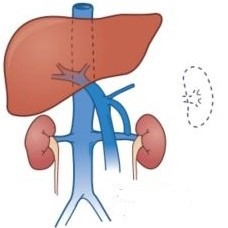 Conventional Splenorenal Portacaval Shunt