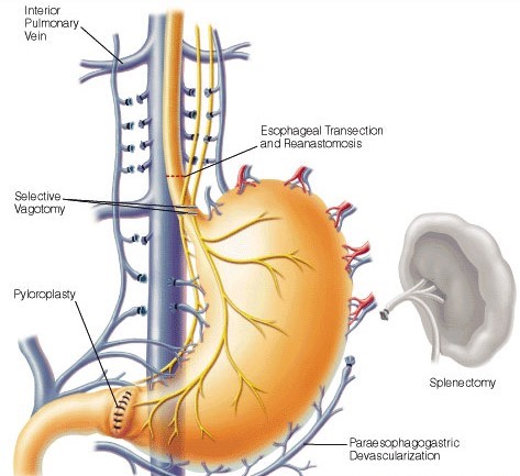 Sugiura Procedure