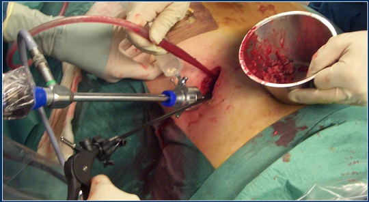 Video-Assisted Retroperitoneal Debridement