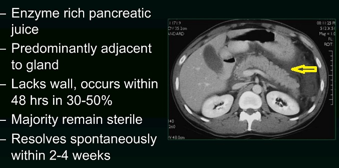 Acute Pancreatitis Fluid Collection