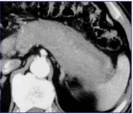 CT - Acute Edematous Pancreatitis