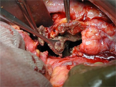 Open Pancreatic Debridement