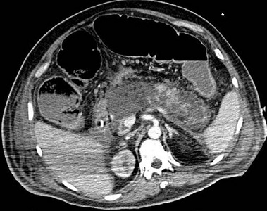 Acute Pancreatitis Necrosis