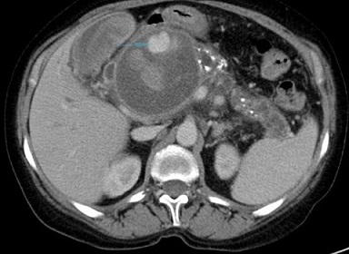 Acute Pancreatitis - Pseudoaneurysm