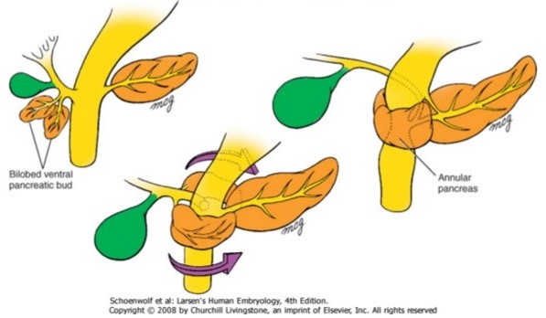 Annular Pancreas