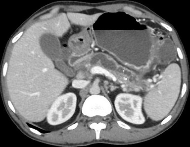 CT - Dilated Pancreatic Duct