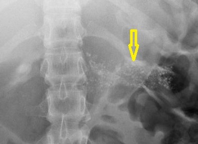 KUB - Calcifications of Chronic Pancreatiis