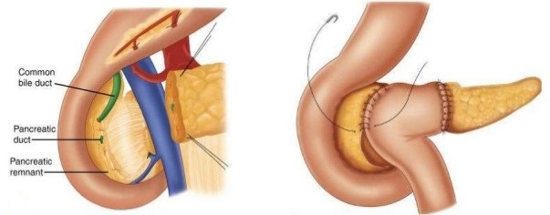 Beger Procedure