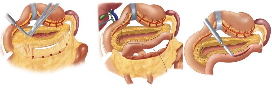 Frey Procedure