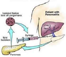 Total Pancreatectomy with Islet Cell Transplantation