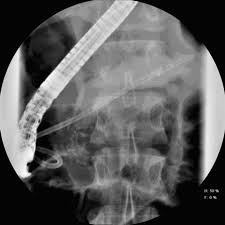 ERCP with Pancreatic Duct Stent Placement