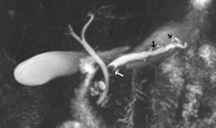 MRCP - Dilated Pancreatic Duct with Obstructing Stone