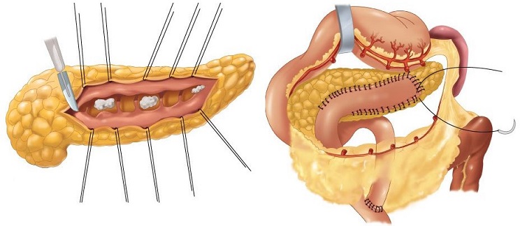 Puestow Procedure