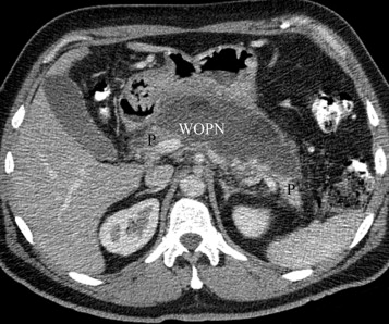 CT - Walled Off Pancreatic Necrosis