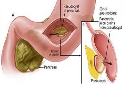 Cystogastrostomy