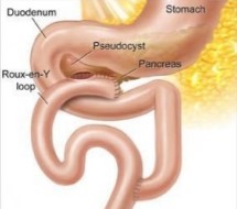 Cystojejunostomy