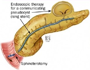 Endoscopic Stent for a Communicating Pseudocyst