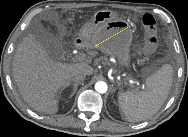 CT - Infected Pseudocyst