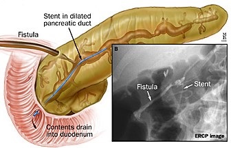 Endoscopic Stent for Pancreatic Ascites