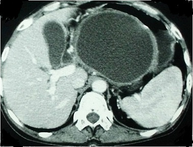 CT - Pancreatic Pseudocyst