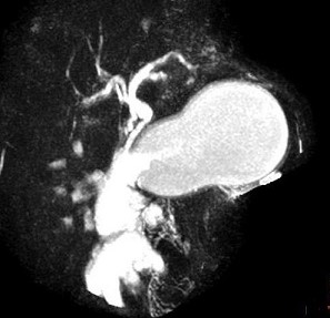 MRCP - Pseudocyst