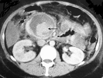 CT - Hemorrhage into Pseudocyst