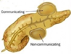 Types of Pseudocysts