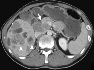 PNET with Extensiver Liver Metastases