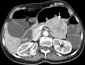 CT - VIPoma