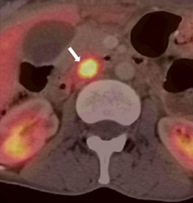 Duodenal Wall Gastrinoma - PET CT