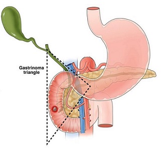 Gastrinoma Triangle