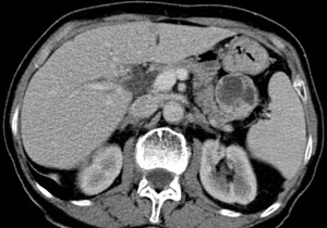 CT - Glucagonoma