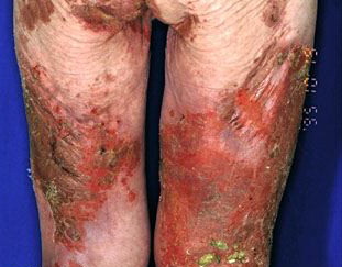 Glucagonoma Necrolytic Dermatitis