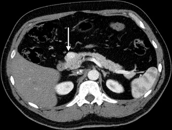 Insulinoma - CT