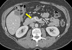 CT - Pancreatic Insulinoma