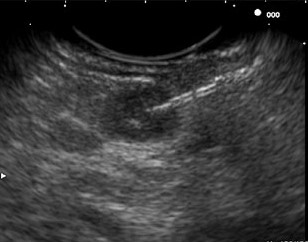 EUS + FNA - Insulinoma