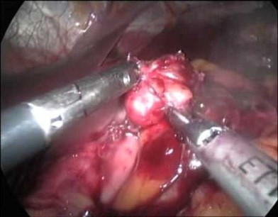 Laparoscopic Enucleation - Pancreatic Insulinoma