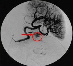 Insulinoma localized by Angiogram