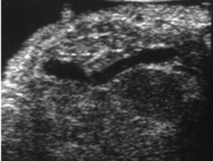 Intraop Ultrasound - Pancreatic Insulinoma